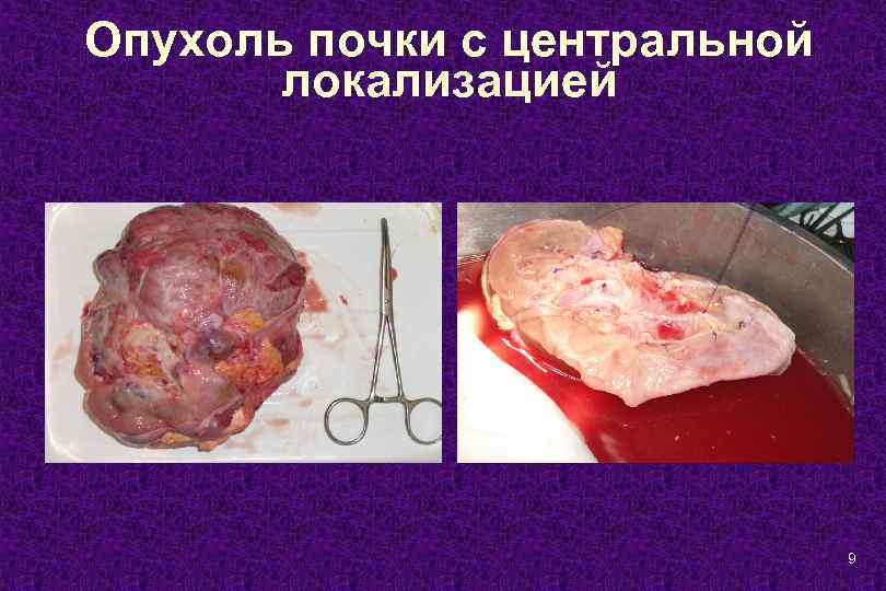 Опухоль почки с центральной локализацией 9 