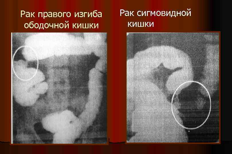 Рак правого изгиба ободочной кишки Рак сигмовидной кишки 