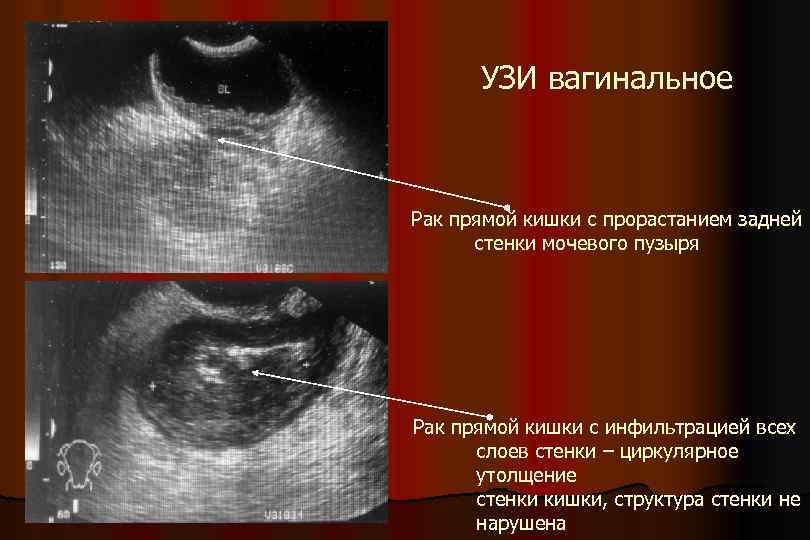 УЗИ вагинальное Рак прямой кишки с прорастанием задней стенки мочевого пузыря Рак прямой кишки