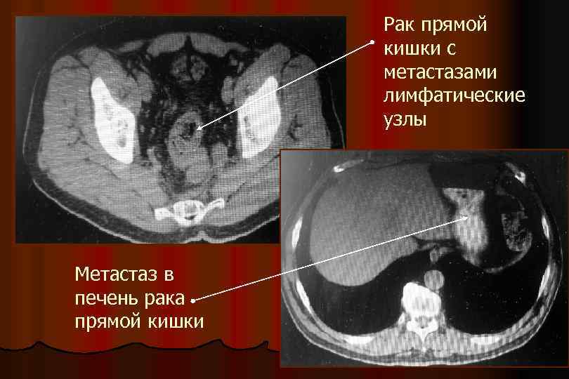 Рак прямой кишки с метастазами лимфатические узлы Метастаз в печень рака прямой кишки 