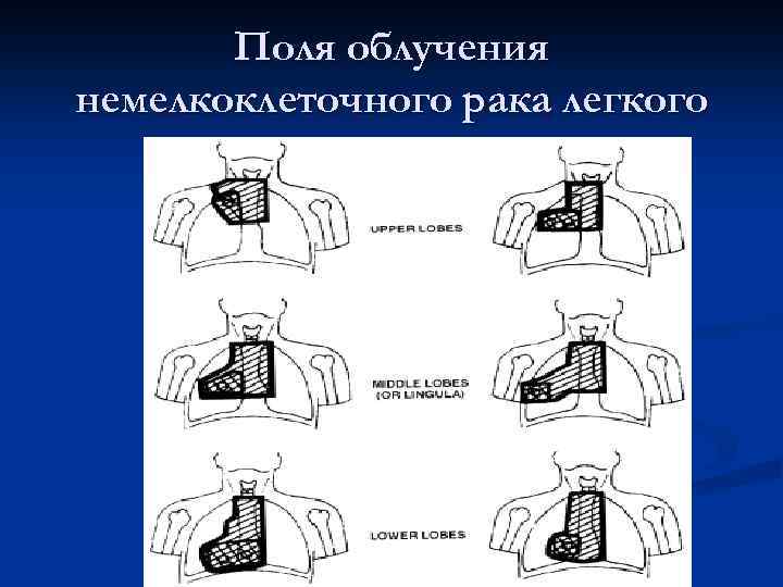 Поля облучения немелкоклеточного рака легкого 