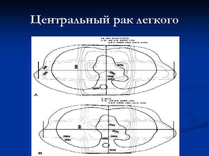 Центральный рак легкого 