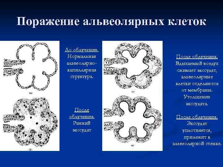 Поражение альвеолярных клеток До облучения. Нормальная альвеолярнокапиллярная структура. После облучения. Ранний экссудат После облучения.