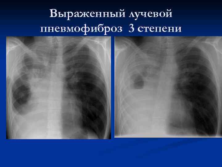 Выраженный лучевой пневмофиброз 3 степени 