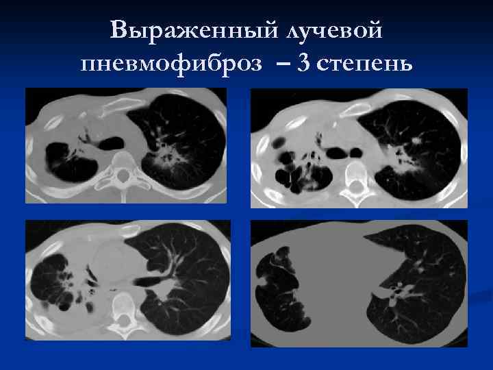 Выраженный лучевой пневмофиброз – 3 степень 