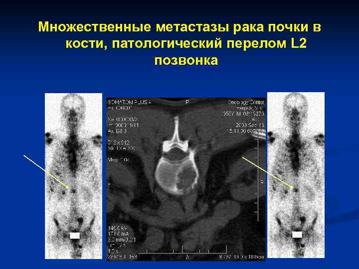 Множественные метастазы рака почки в кости, патологический перелом L 2 позвонка 