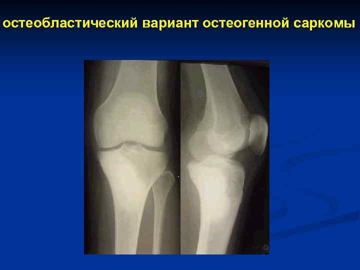 остеобластический вариант остеогенной саркомы 