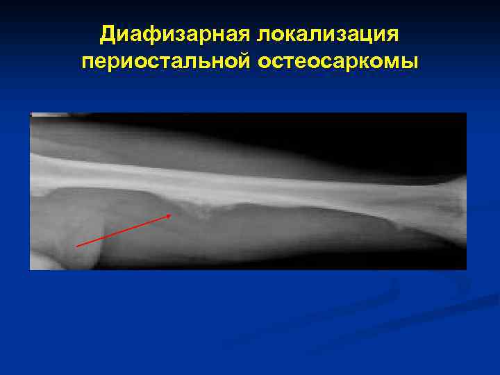 Диафизарная локализация периостальной остеосаркомы 