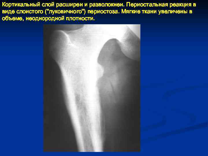 Кортикальный слой расширен и разволокнен. Периостальная реакция в виде слоистого ("луковичного") периостоза. Мягкие ткани