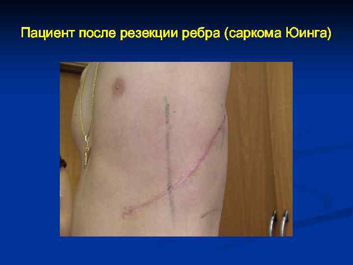 Пациент после резекции ребра (саркома Юинга) 