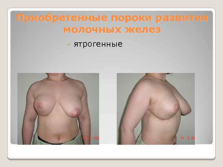 Приобретенные пороки развития молочных желез - ятрогенные 