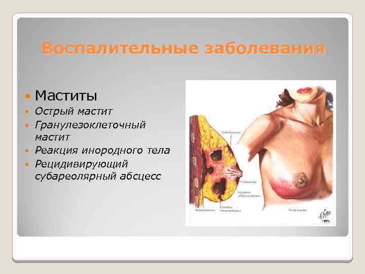 Воспалительные заболевания Маститы Острый мастит Гранулезоклеточный мастит Реакция инородного тела Рецидивирующий субареолярный абсцесс 