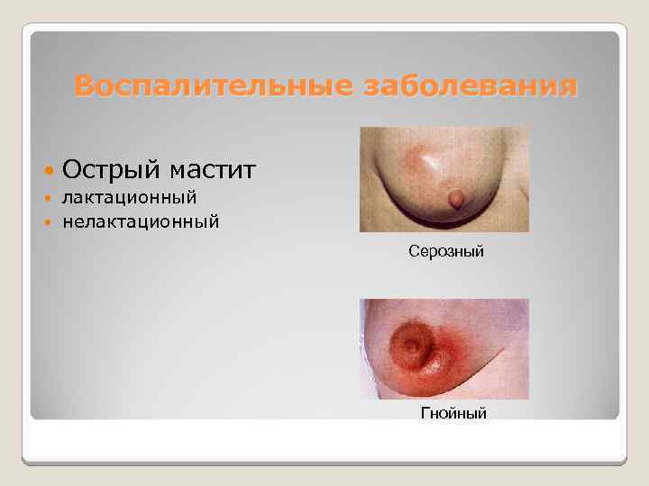 Воспалительные заболевания Острый мастит лактационный нелактационный Серозный Гнойный 
