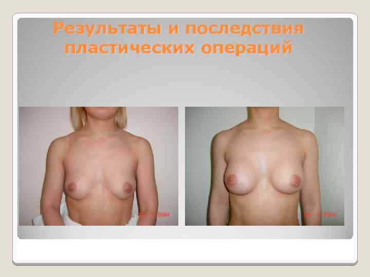 Результаты и последствия пластических операций 