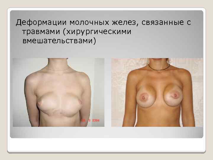 Деформации молочных желез, связанные с травмами (хирургическими вмешательствами) 