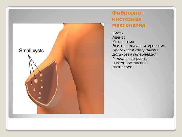 Фибрознокистозная мастопатия Кисты Аденоз Метаплазия Эпителиальная гиперплазия Протоковая гиперплазия Дольковая гиперплазия Радиальный рубец Внутрипротоковая