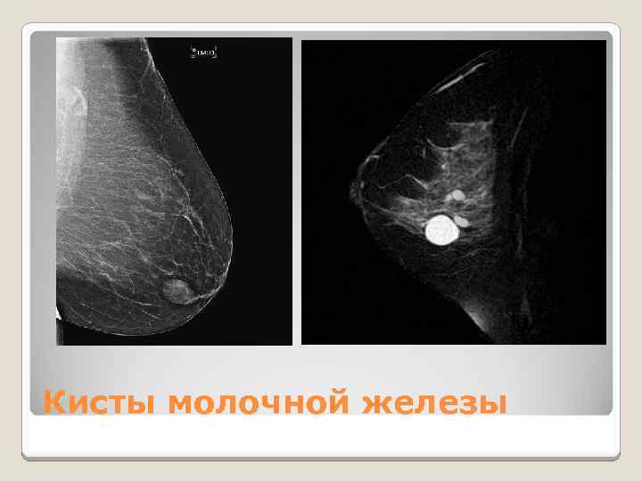 Кисты молочной железы 