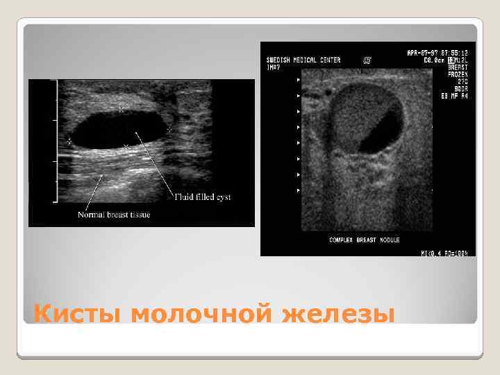 Кисты молочной железы 