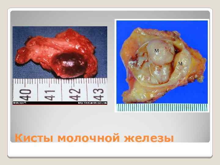Кисты молочной железы 