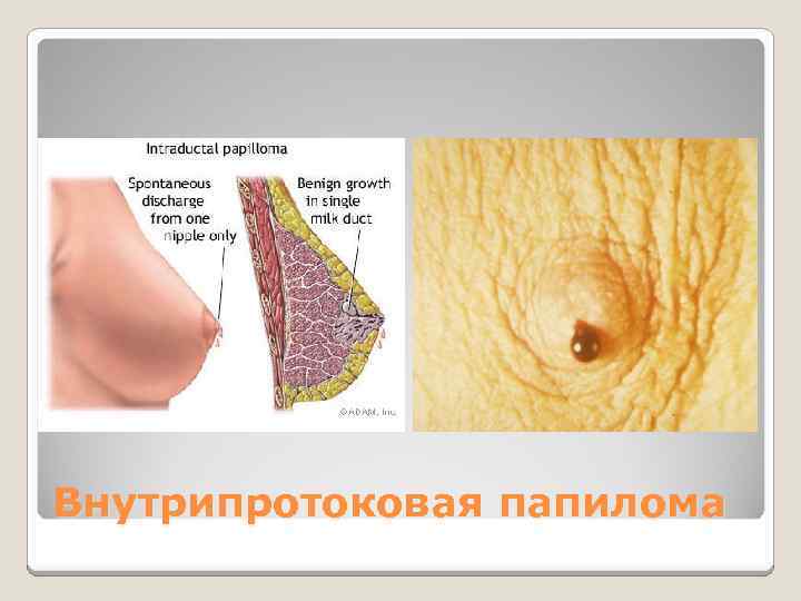 Внутрипротоковая папилома 