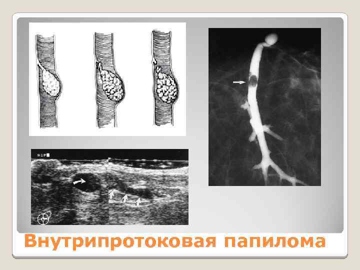 Внутрипротоковая папилома 