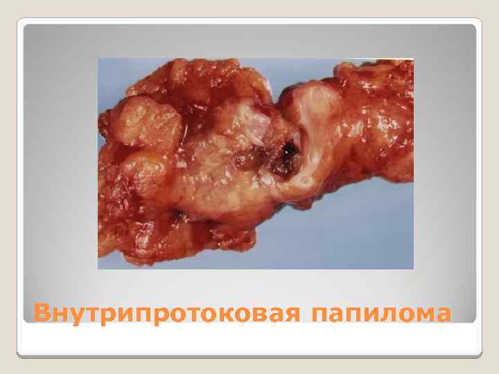 Внутрипротоковая папилома 