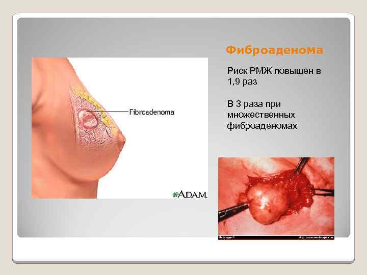 Фиброаденома Риск РМЖ повышен в 1, 9 раз В 3 раза при множественных фиброаденомах