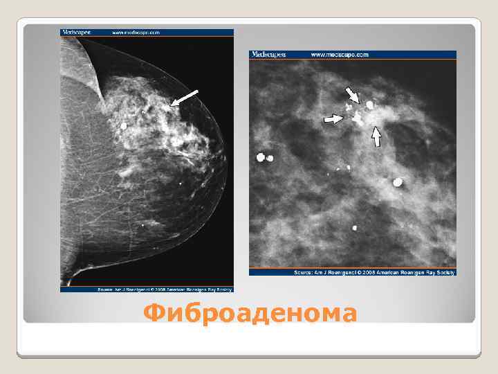 Фиброаденома 