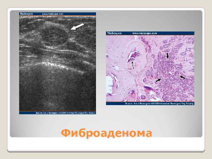 Фиброаденома 