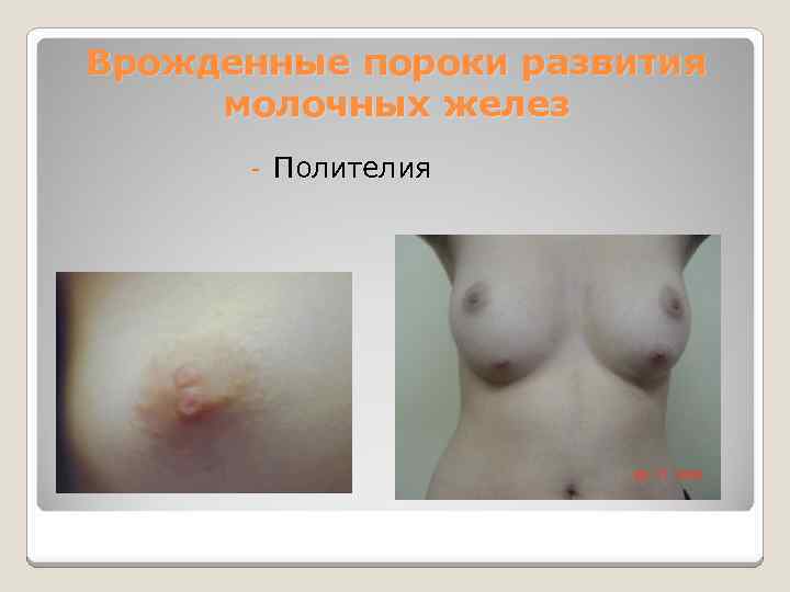 Врожденные пороки развития молочных желез - Полителия 