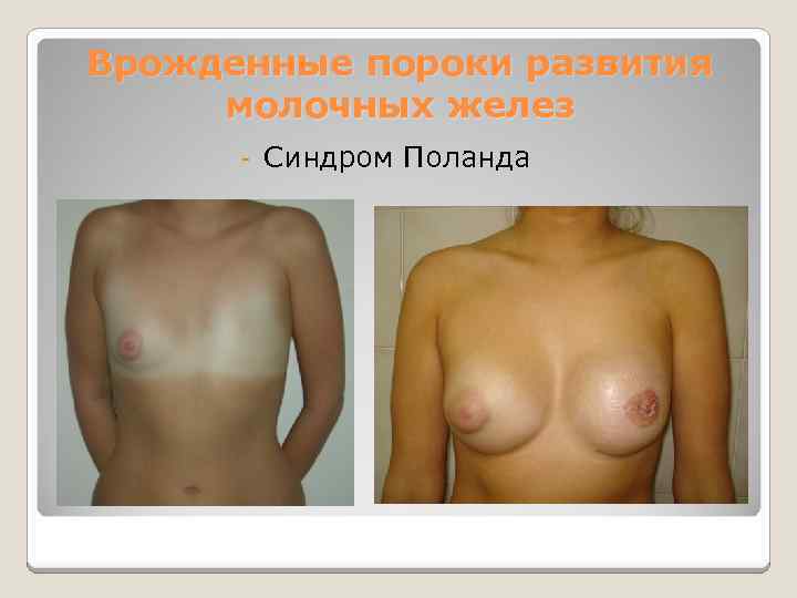 Врожденные пороки развития молочных желез - Синдром Поланда 