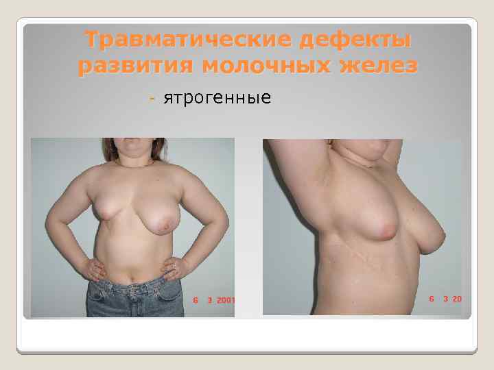 Травматические дефекты развития молочных желез - ятрогенные 