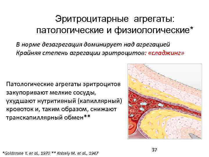 Эритроцитарные агрегаты: патологические и физиологические* В норме дезагрегация доминирует над агрегацией Крайняя степень агрегации