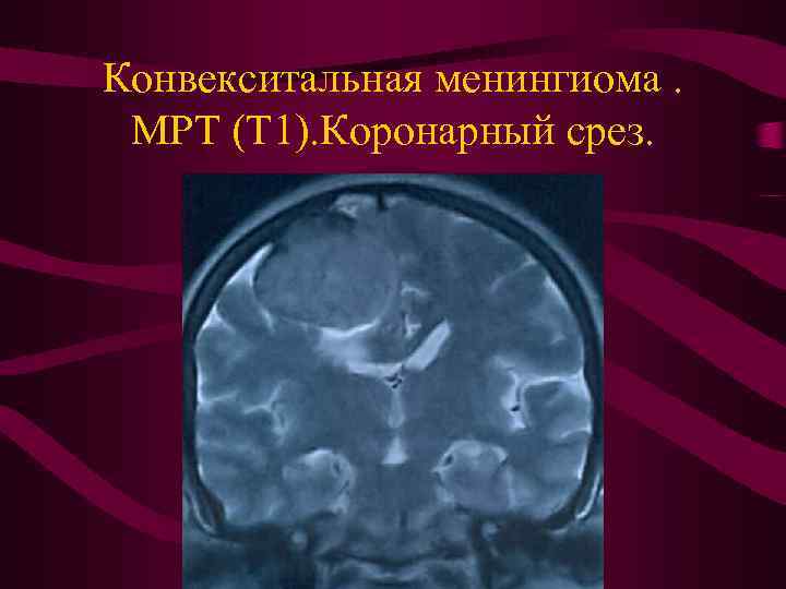 Конвекситальная менингиома. МРТ (Т 1). Коронарный срез. 