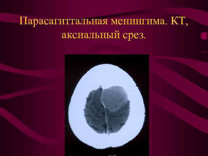 Парасагиттальная менингима. КТ, аксиальный срез. 