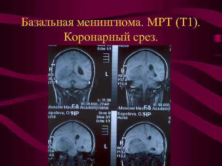 Базальная менингиома. МРТ (Т 1). Коронарный срез. 