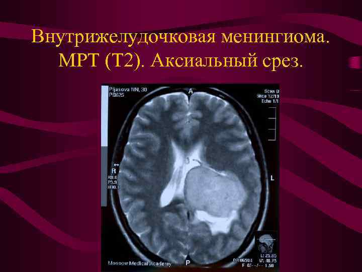 Внутрижелудочковая менингиома. МРТ (Т 2). Аксиальный срез. 