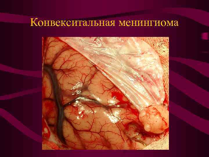 Конвекситальная менингиома 