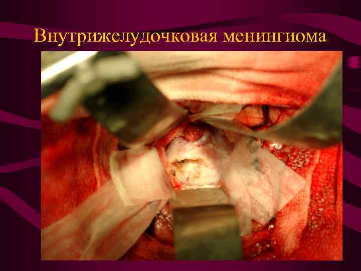 Внутрижелудочковая менингиома 