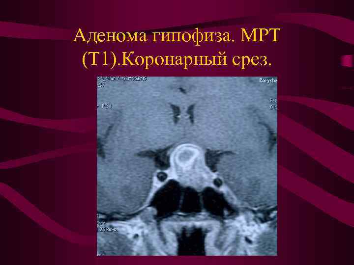 Аденома гипофиза. МРТ (Т 1). Коронарный срез. 