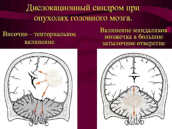 Дислокационный синдром при опухолях головного мозга. Височно – тенториальное вклинение Вклинение миндаликов мозжечка в