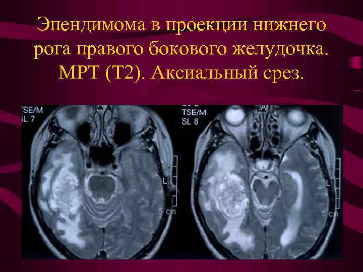 Эпендимома в проекции нижнего рога правого бокового желудочка. МРТ (Т 2). Аксиальный срез. 