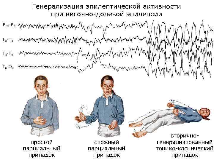 Генерализация эпилептической активности при височно-долевой эпилепсии простой парциальный припадок сложный парциальный припадок вторичногенерализлованный тонико-клонический
