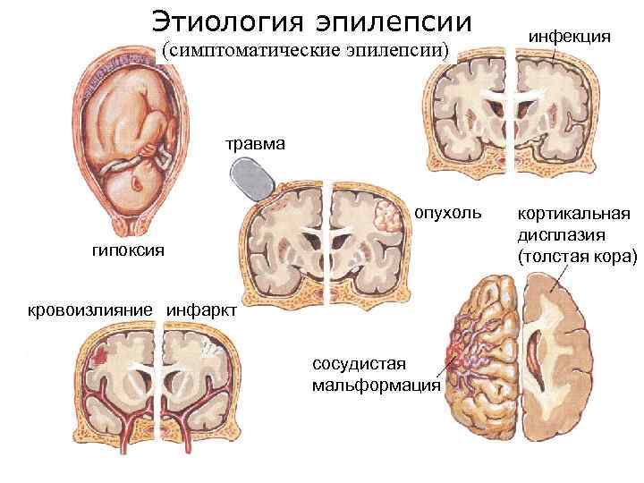 Этиология эпилепсии (симптоматические эпилепсии) инфекция травма опухоль гипоксия кровоизлияние инфаркт сосудистая мальформация кортикальная дисплазия