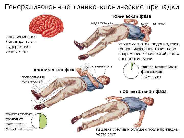 Генерализованные тонико-клонические припадки тоническая фаза недержание одновременная билатеральная судорожная активность клоническая фаза подергивание конечностей