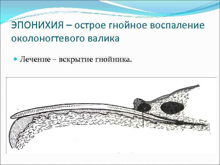 ЭПОНИХИЯ – острое гнойное воспаление околоногтевого валика Лечение – вскрытие гнойника. 