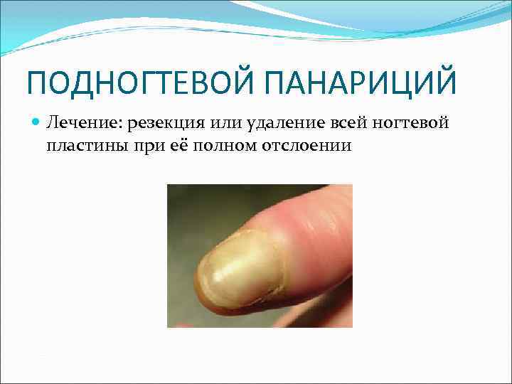 ПОДНОГТЕВОЙ ПАНАРИЦИЙ Лечение: резекция или удаление всей ногтевой пластины при её полном отслоении 