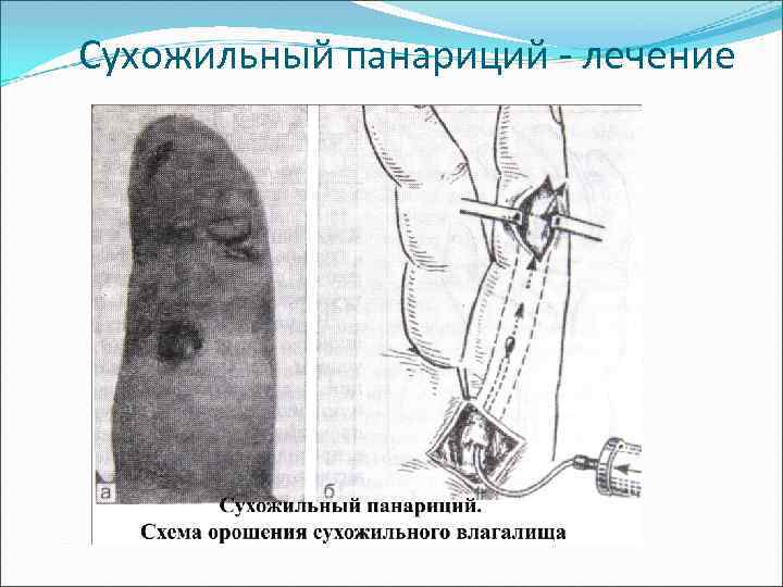 Сухожильный панариций - лечение 