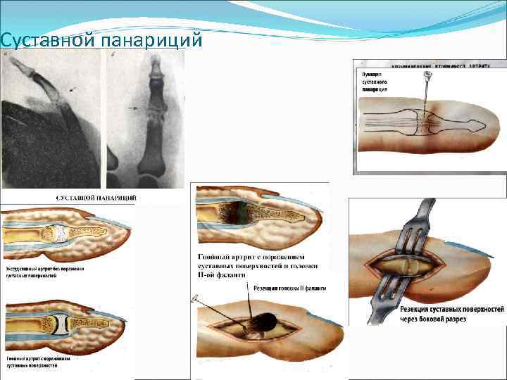 Суставной панариций 