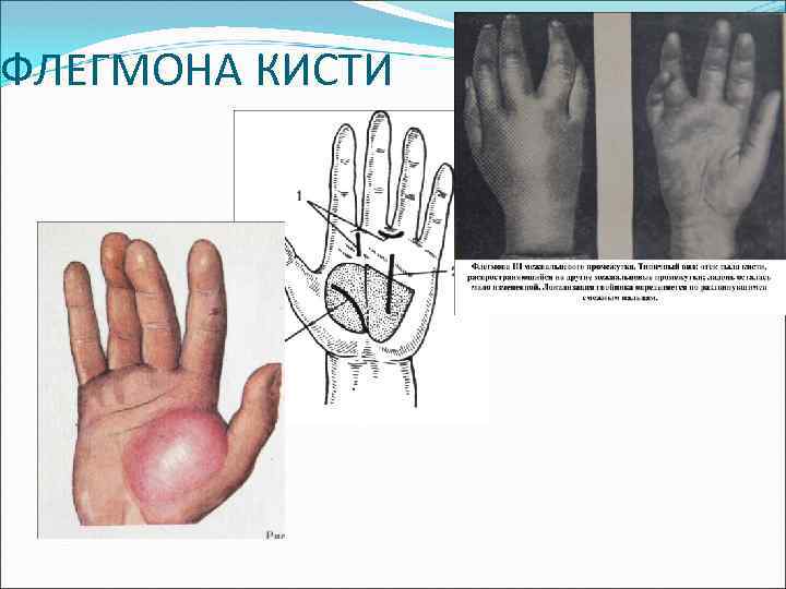 ФЛЕГМОНА КИСТИ 
